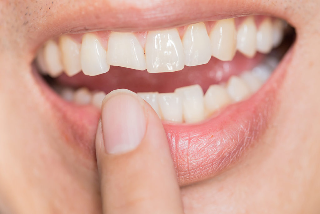 Fisuras dentales: tipos de grietas en los dientes y cómo tratarlas