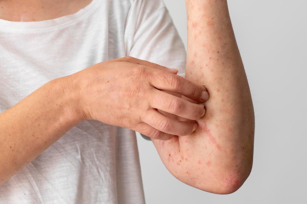 Dermatitis atópica: qué es y cómo tratarla